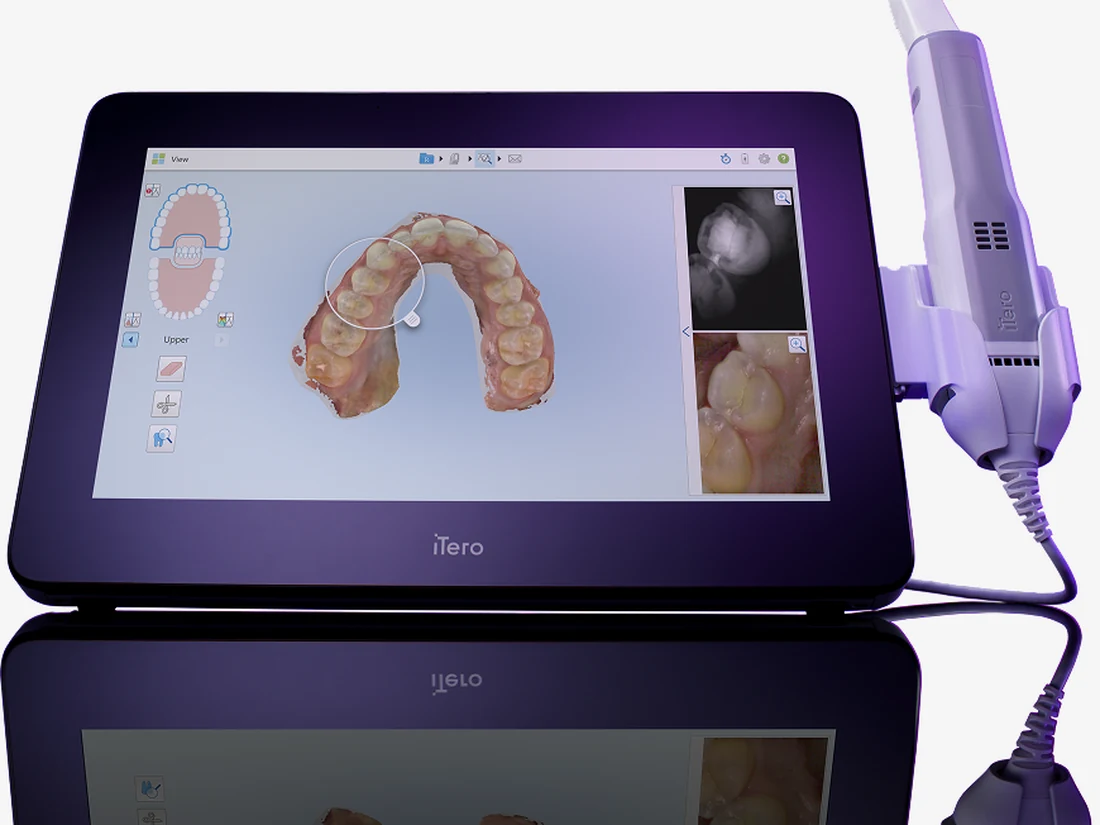 Tela do iTero com o modelo 3D da arcada e o scanner ao lado